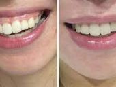 NHA KHOA UY TÍN NÀO ĐIỀU TRỊ CƯỜI HỞ LỢI TỐT NHẤT?