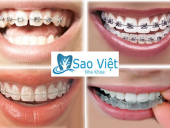 Nên Chọn Dịch Vụ Niềng Răng Uy Tín Giá Rẻ Ở Đâu?