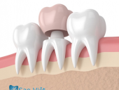 Nha Khoa Làm Răng Sứ Và Những Điều Cần Biết