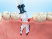 ĐƠN VỊ NHA KHOA PHÚ NHUẬN CHỮA TIÊU XƯƠNG RĂNG HIỆU QUẢ