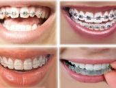 NIỀNG RĂNG ẢNH HƯỞNG ĐẾN THẨM MỸ RĂNG HÀM THẾ NÀO?